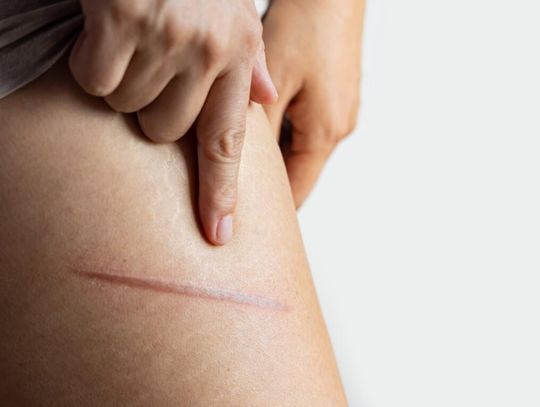 5 sposobów na pozbycie się blizn – szybko, skutecznie i bez bólu