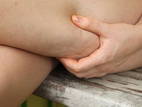 Jak pozbyć się cellulitu w kilka tygodni? Sprawdź!