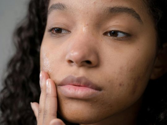 Laserowe leczenie trądziku - efekty i bezpieczeństwo