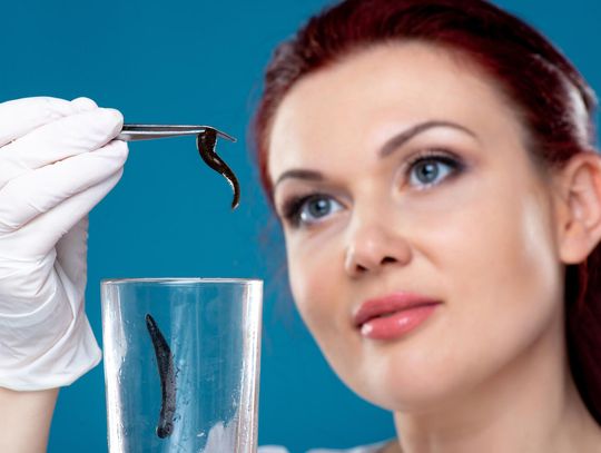 Pijawki medyczne a przeszczep skóry