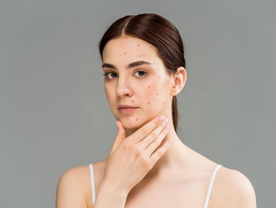 Trądzik a łojotokowe zapalenie skóry