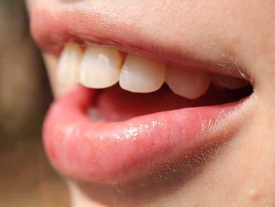 Wszystko co musisz wiedzieć o wybielaniu zębów