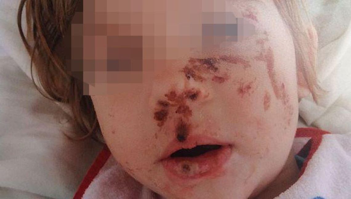 Twarz dziewczynki toczyły rozległe pęcherze, które pękały, tworząc palące rany. Wchłaniały się i pojawiały nowe, nie gojąc się nigdy do końca. Na brodzie pozostały po nich grube bliznowce, na policzkach głębokie szramy