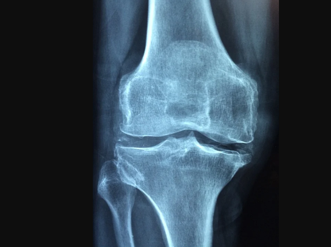 Sprawdź kości. Badania w kierunku osteoporozy